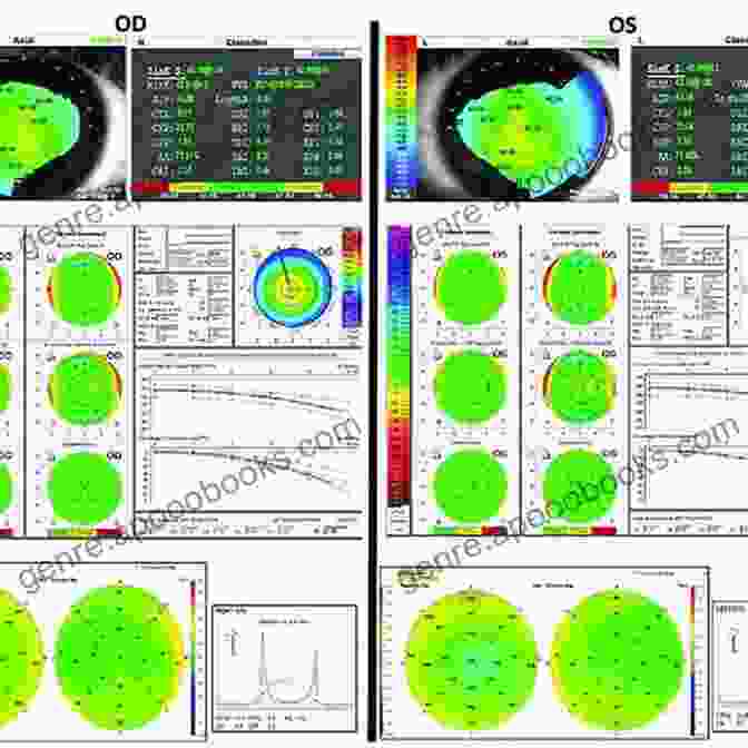 Corneal Tomography Enhancing Diagnostic Capabilities Corneal Tomography In Clinical Practice (Pentacam System): Basics And Clinical Interpretation