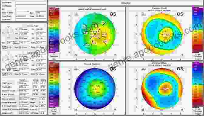 Corneal Tomography For Monitoring Corneal Changes Corneal Tomography In Clinical Practice (Pentacam System): Basics And Clinical Interpretation