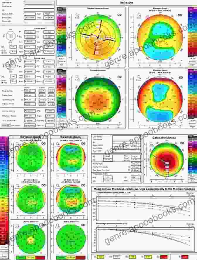 Corneal Tomography For Preoperative Planning Corneal Tomography In Clinical Practice (Pentacam System): Basics And Clinical Interpretation