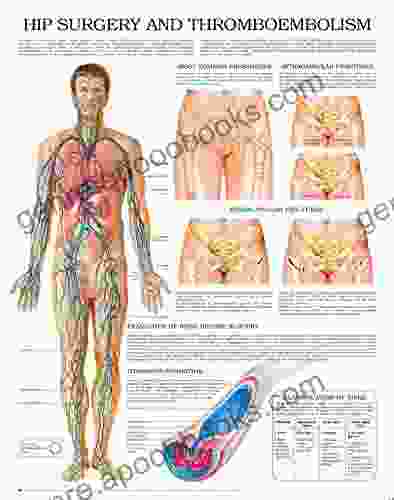 Hip Surgery And Thromboembolism E Chart: Full Illustrated